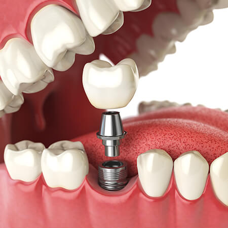 A graphic of the different parts of a dental implant